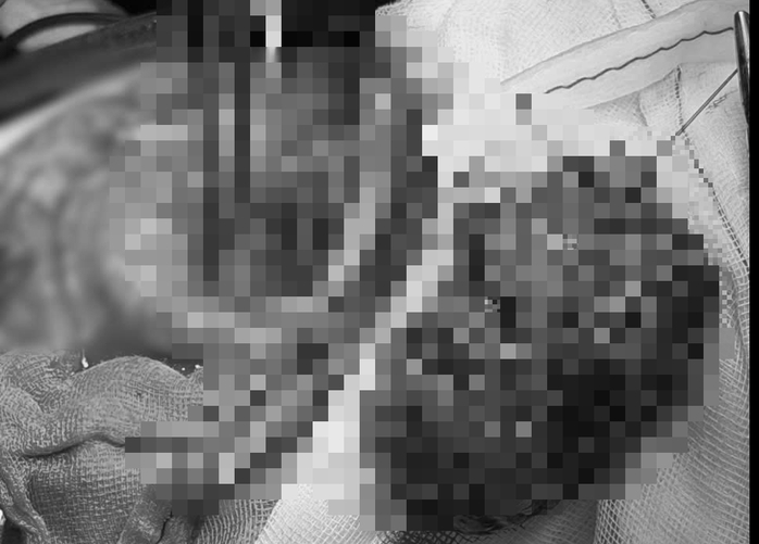 base64-17643839393061117502321 Nhức đầu kéo dài, đi khám mới biết có khối u lớn bằng quả cam - Ảnh 2.