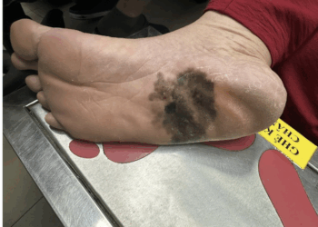 Đốm đen trên da, khi nào là dấu hiệu của ung thư da? - Ảnh 2.