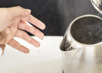 Bé 9 tháng tuổi bỏng 30% cơ thể do kéo dây ấm siêu tốc - Ảnh 1.