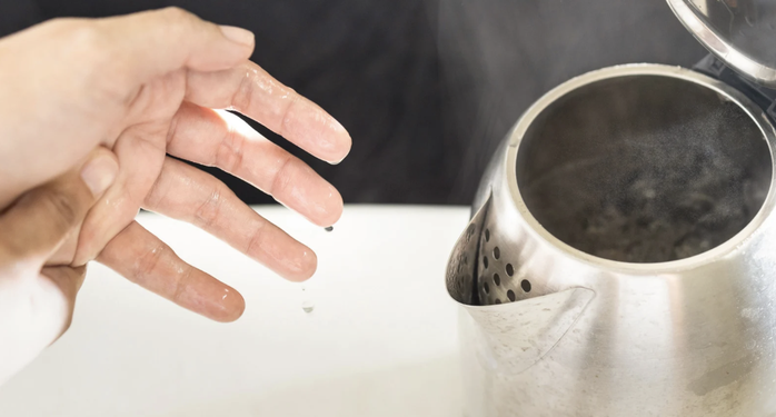 Bé 9 tháng tuổi bỏng 30% cơ thể do kéo dây ấm siêu tốc - Ảnh 1.